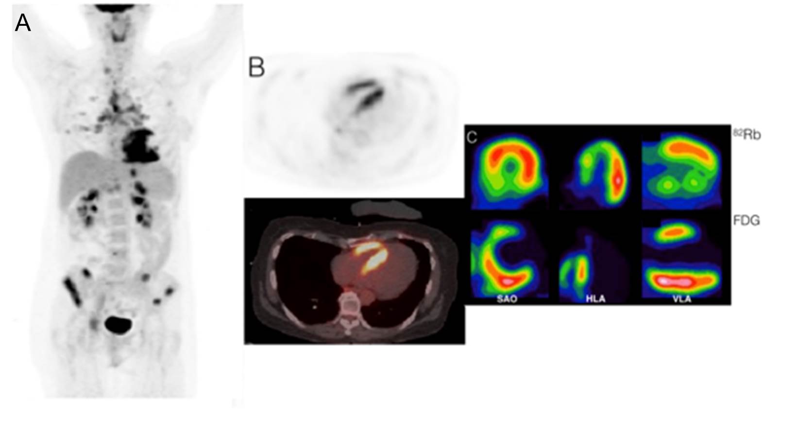 FDG PET for Cardiac Sarcoid American College of Cardiology